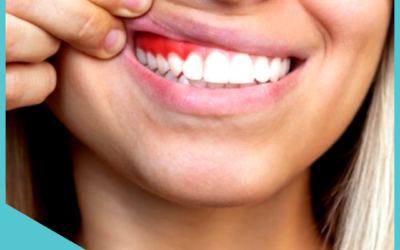 WHAT CAN BLEEDING FROM YOUR GUMS MEAN?
