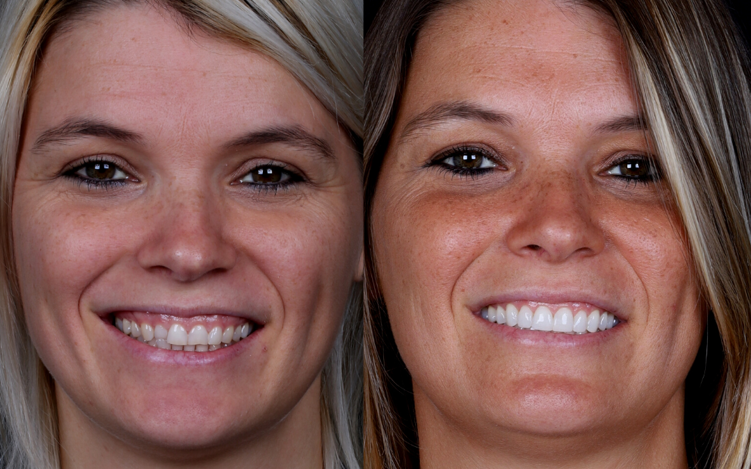 Gingivoplasty – one of the procedures that correct gingival smile