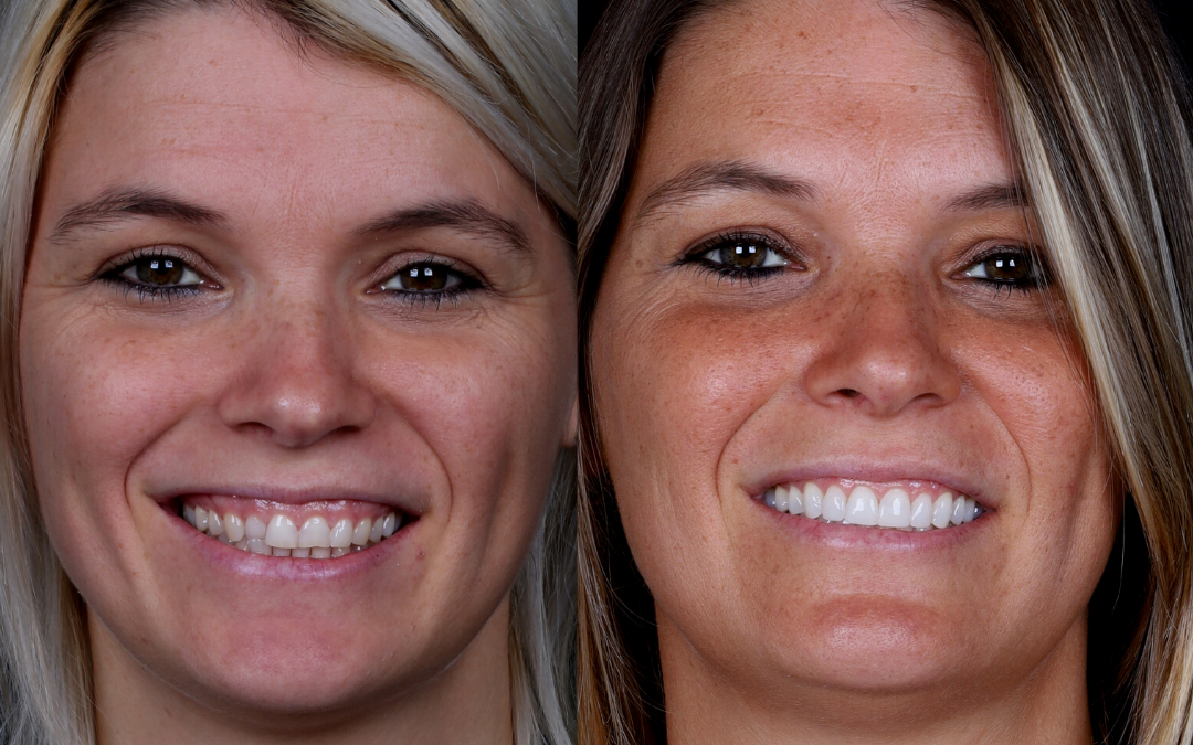 Gingivoplastie – une des procédures qui corrigent le sourire gingival