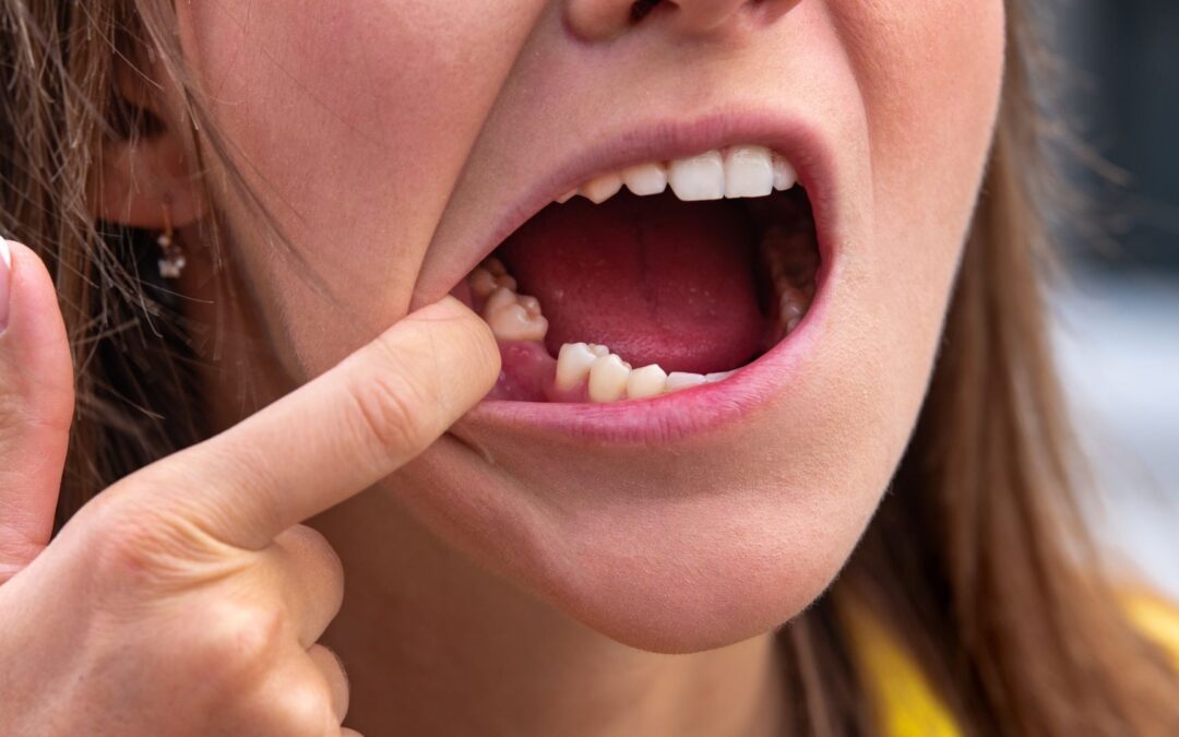 Motivos para a perda dentária